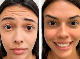 botox-em-imbe